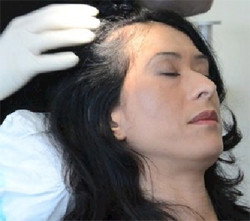 Hair Transplant Abroad - Adelaide Hairdresser 1