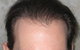 Hair Transplant Abroad - thumb 3