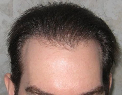 Hair Transplant Abroad - Adelaide Hairdresser 3