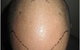 Hair Transplant Abroad - thumb 5